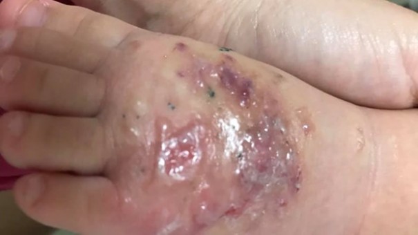 Criana pega infeco aps brincar em praa de Tup