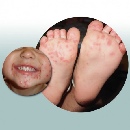 Pediatra alerta para os cuidados com a Síndrome mão-pé-boca