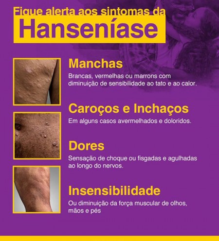 Casos suspeitos de hanseníase serão atendidos nesta quinta-feira em Adamantina