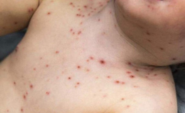 Osvaldo Cruz tem quatro casos suspeitos de Sarampo