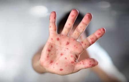 Sarampo: Osvaldo Cruz teve 8 casos suspeitos da doença em 2019