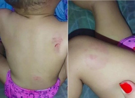 Mãe registra boletim de ocorrência após buscar bebê em creche com mordidas pelo corpo