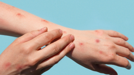  Tupã investiga primeiro caso suspeito de varíola dos macacos