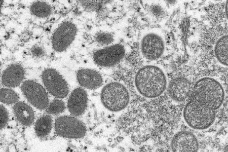 Brasil tem dois casos suspeitos de varíola dos macacos, diz Ministério da Saúde
