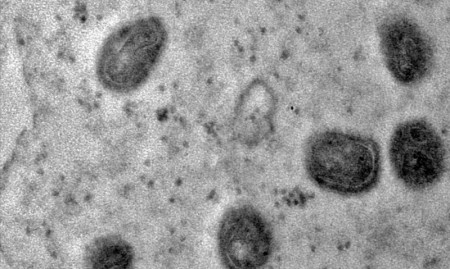 Prudente confirma dois novos casos de varíola dos macacos