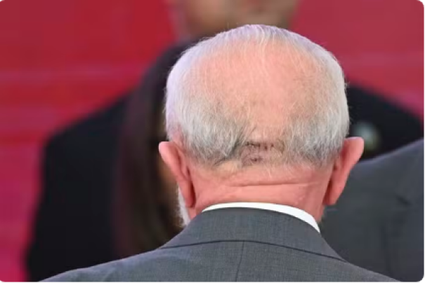 Após cirurgia, Lula conversa, se alimenta normalmente e não terá sequelas, dizem médicos