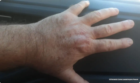 Fiocruz: estudo reduz riscos do tratamento contra leishmaniose cutÃ¢nea