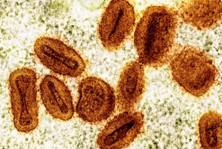 Grupo de VigilÃ¢ncia EpidemiolÃ³gica confirma 3 casos de mpox em Presidente EpitÃ¡cio; total no Oeste Paulista chega a 12 neste ano