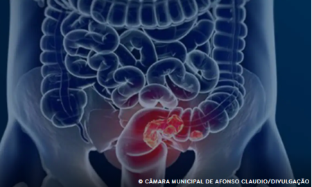 Estudo projeta aumento de 36% em mortes por cÃ¢ncer colorretal atÃ© 2040