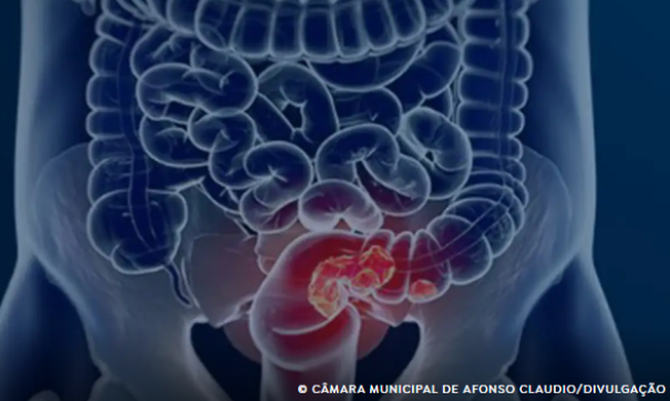 Estudo projeta aumento de 36% em mortes por câncer colorretal até 2040