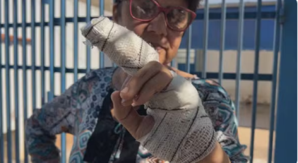 Mulher tem parte do dedo decepado após ataque de pitbull em Marília