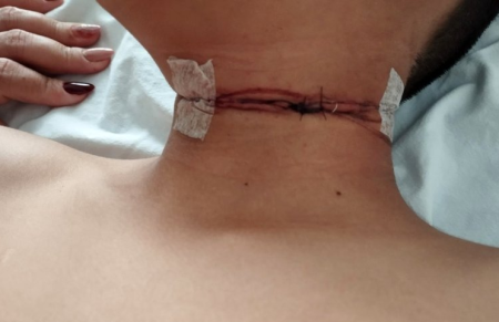 CrianÃ§a fica gravemente ferida apÃ³s acidente com linha chilena em TupÃ£