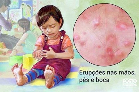 Informações indicam registro da síndrome Mão-Pé-Boca em Osvaldo Cruz