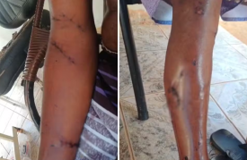 Homem de 61 anos Ã© atacado por pitbull e fica ferido em Tarabai