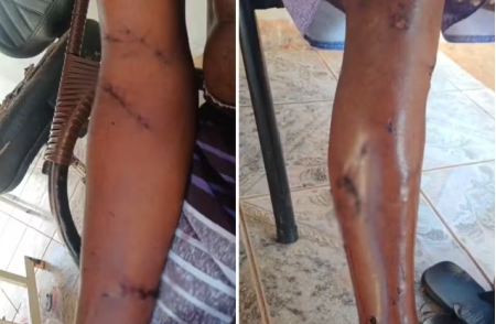Homem de 61 anos Ã© atacado por pitbull e fica ferido em Tarabai