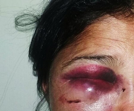  Mulher é agredida pelo amásio com golpe de panela de pressão quente